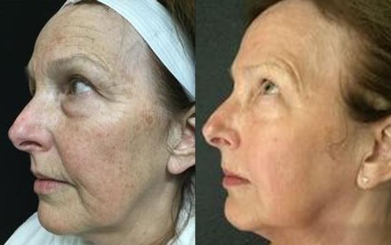 Microneedling with Radiofrequency | Fractora Laser Near Me