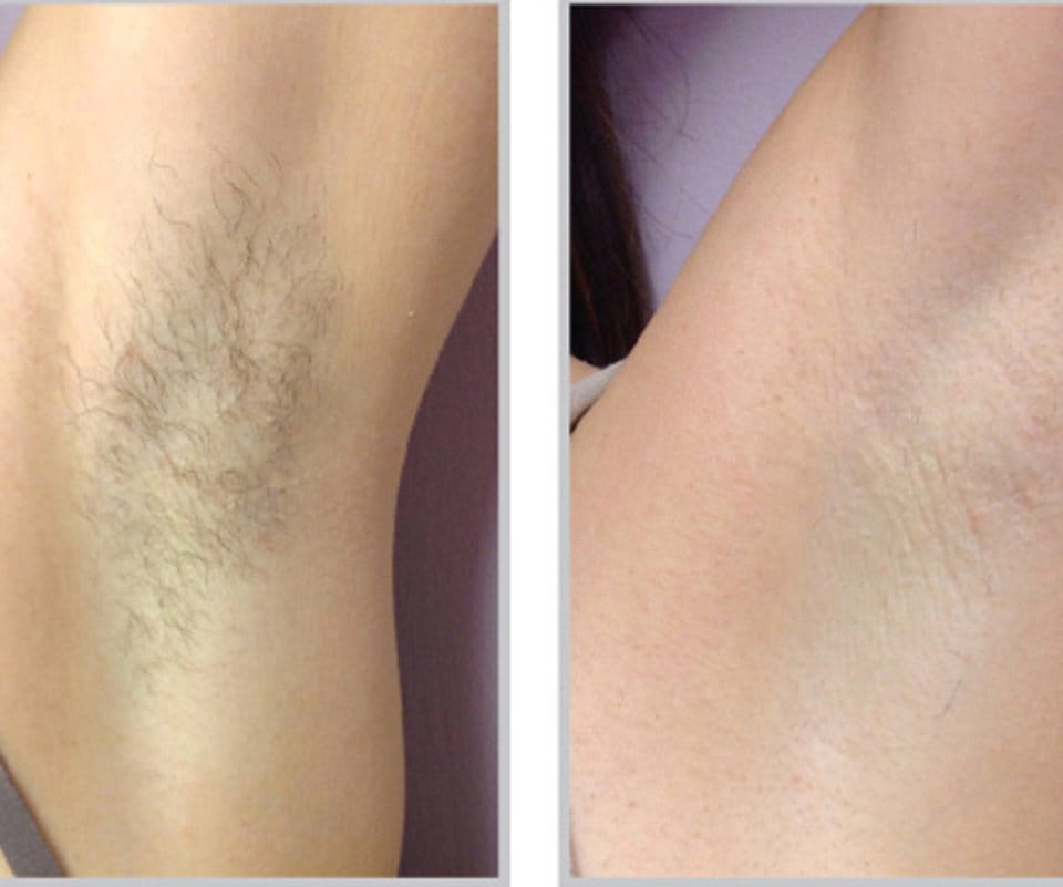 Laser Hair Removal Gallery Skintegrity Medspa
